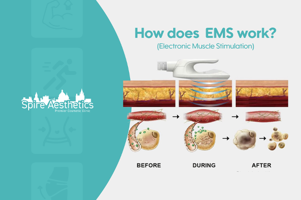 EMS treatment for post pregnancy weight loss treatment Chorley