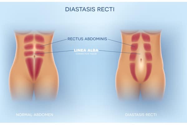 What Non-Surgical Options Are Available for Diastasis Recti Chorley?