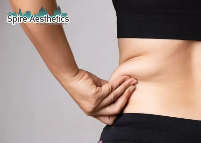 Image of woman pinching fat on their hips Chorley. Fat Freezing treatment
