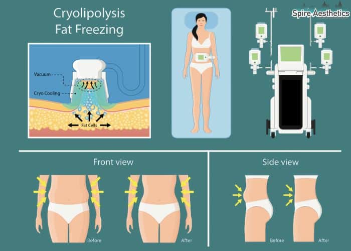 Image of diet and fat freezing combined for best results for Spire Aesthetics Chorley