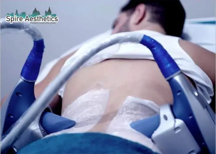Man having fat freezing treatment done on love handles before a competitions Chorley to create a sculpted look.
