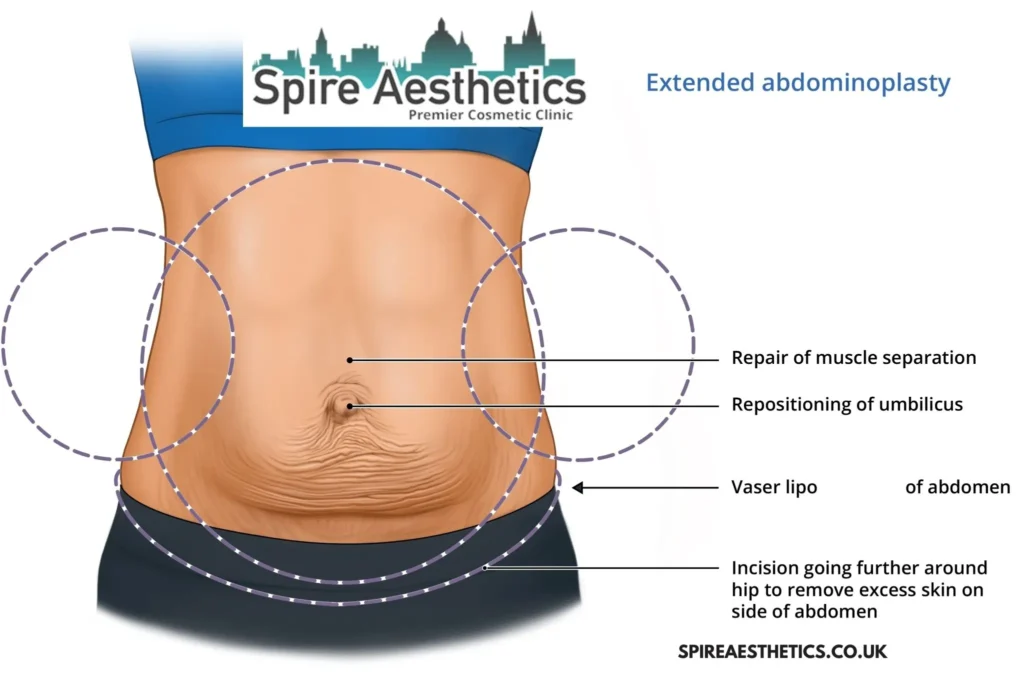 Understanding Loose Skin After Gastric Band Chorley Surgery and HIFU Treatment