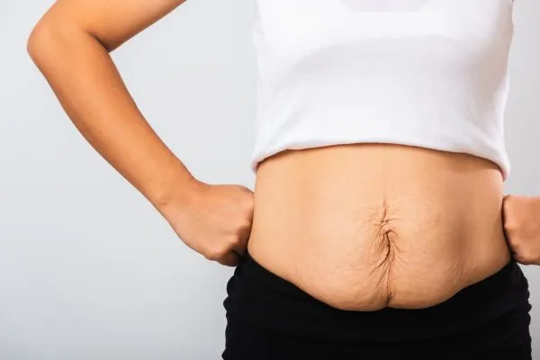Image of a woman's stomach after weight loss with sagging skin following a gastric band Chorley