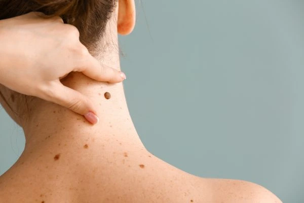 skin blemish removal Chorley treatment