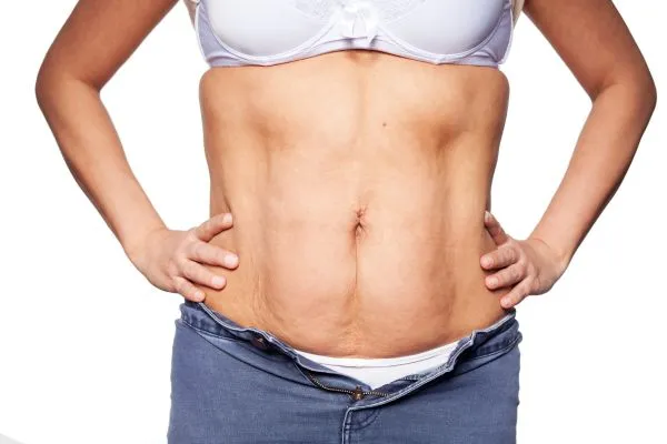 sagging skin on woman's stomach after weight loss injections Chorley