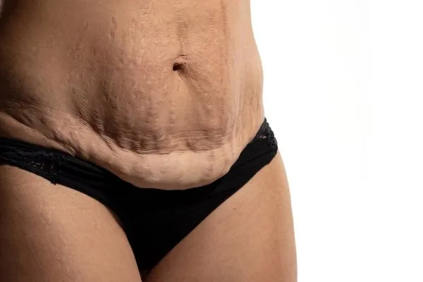 Image of womans stomach after weight loss injections Chorley showing saggy skin