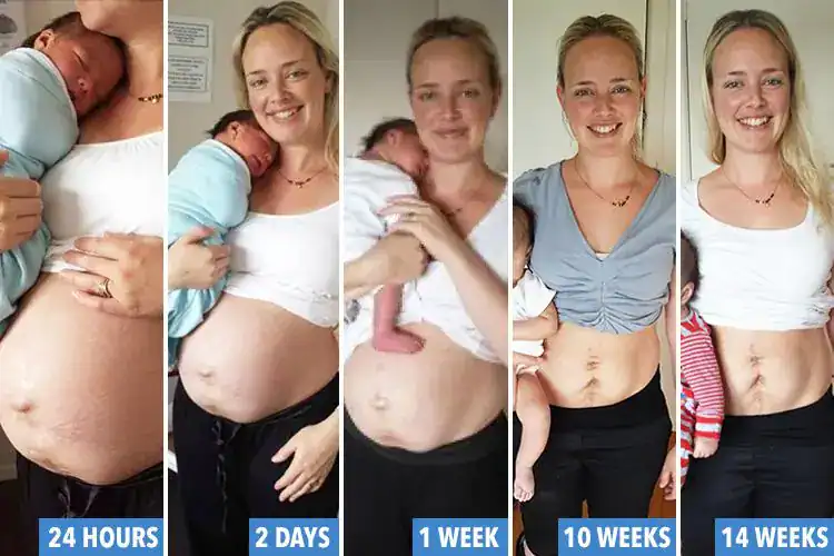 How Long Does It Take for Your Stomach to Go Back to Normal After Pregnancy?