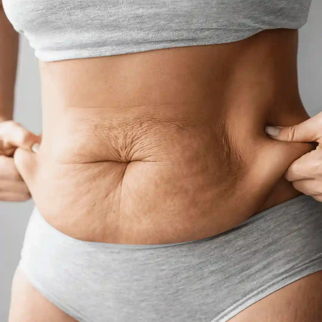 Is It Normal to Have Loose Skin After Pregnancy Chorley?