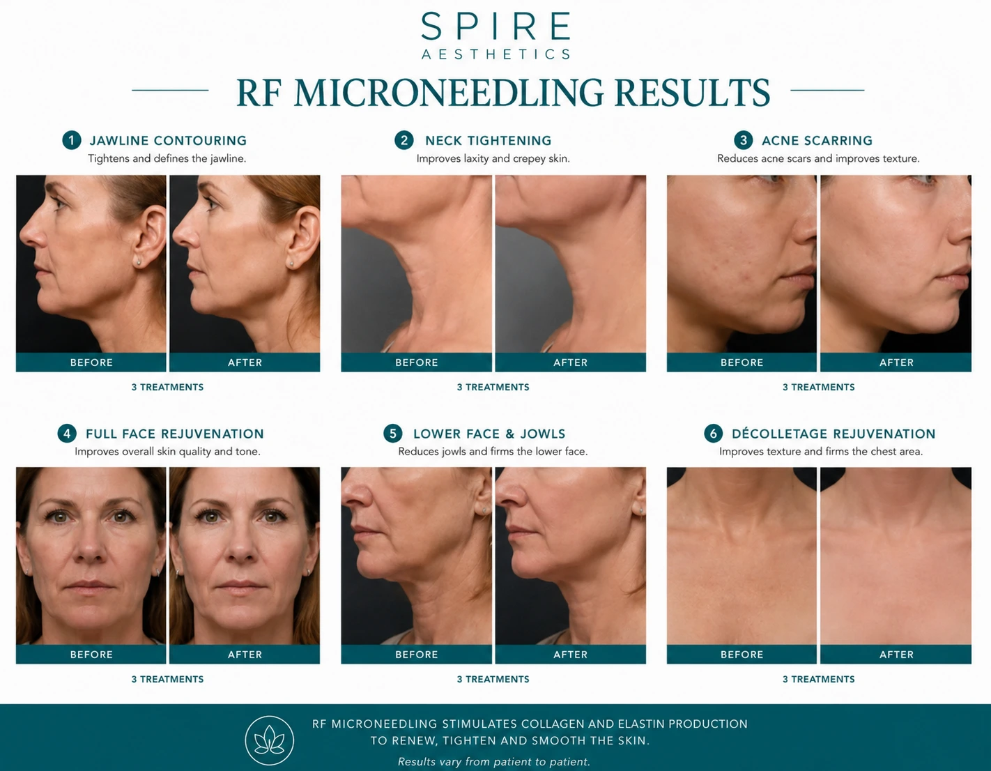 RF Microneedling Skin tightening Chorley results