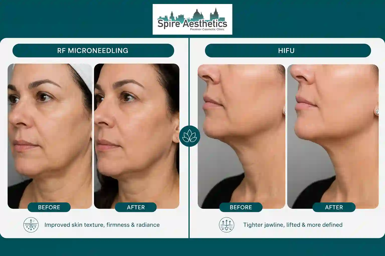 Can RF Microneedling and HIFU Be Combined Chorley?