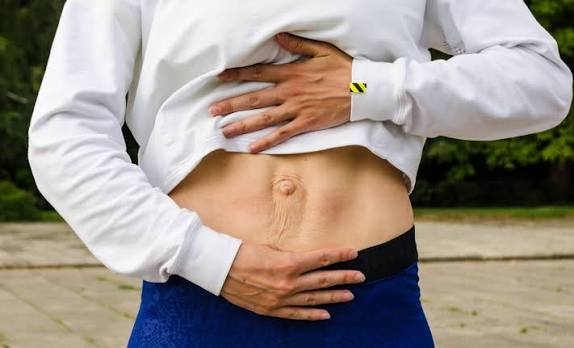 When Could Diastasis Recti Be the Missing Piece of the Puzzle Chorley?