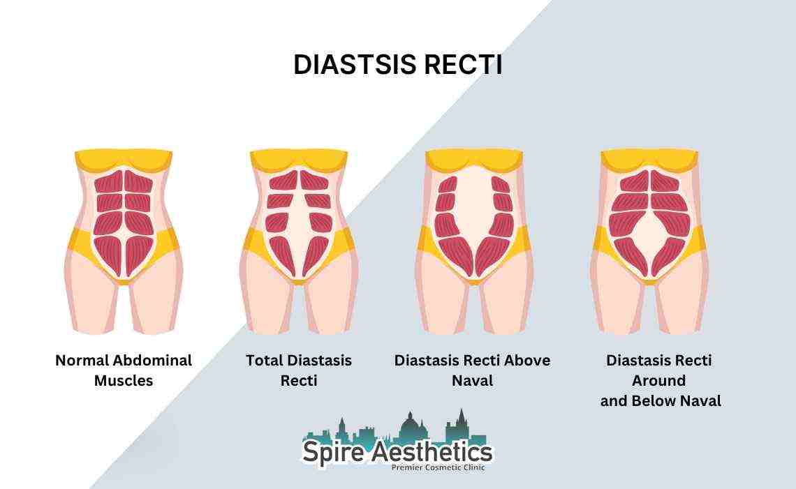 Is Non-Surgical Diastasis Recti Treatment Right for You? Common Concerns Answered Chorley